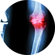 Fracture Injury Claims Lawyers Toronto